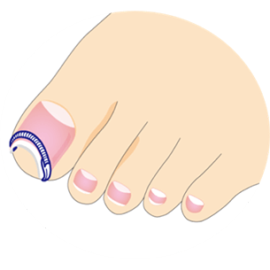 装着の適応となる方